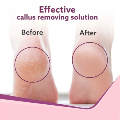 Callus Remover with 3 Interchangeable Head Rollers, Electronic Foot Scrubber For Callus & Dead Skin Removal, Pedicure Device, 2 Speed, Rechargeable Foot Care, Waterproof, CR1727, Pink - Image 4